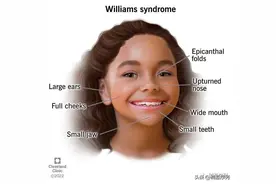 小精灵面容——7q11.23缺失综合征图片