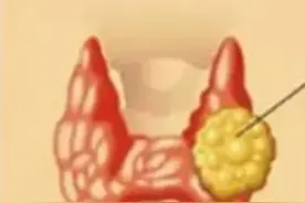 值得收藏的10种消除结节的中草药图片