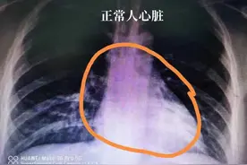 “大心脏”是好事吗？医生直言：心脏扩大，和心血管疾病有关图片