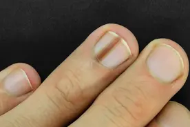 体内有癌，指甲先知？指甲出现6种异常，或是患病信号图片