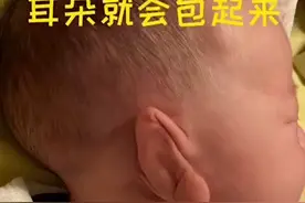 【0-3岁使用，越早效果越好】纠正0-3岁婴幼儿童耳廓...图片