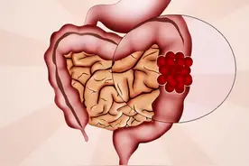 20多岁女青年一天放屁30多次，确诊肠癌晚期！2种屁或是肠癌信号图片