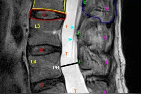 （收藏）腰椎MRI怎么阅片呢？腰椎间盘突出如何看？零基础可读懂图片