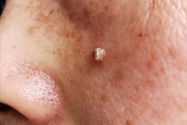 hpv和病毒疣都啥模样?