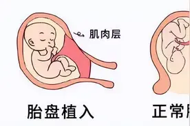 胎盘植入如此凶险！罪魁祸首是什么？图片