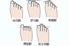 大脚趾长歪了，怎么办？拇外翻应该如何改善？图片