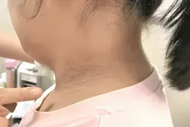 小胖娃脖子上一圈黑、洗不掉？小心是“黑棘皮病”，需要减重图片