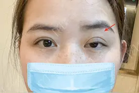 眼睛一大一小是什么原因？如何改善呢？图片