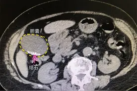 胆囊切除后，有哪些后遗症？医生：这4种“结局”不好受，了解下图片