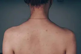 后背反复长痘痘，不妨尝试一下这4个小妙招，或能达到理想效果图片