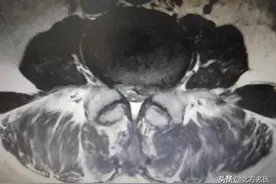 腰腿疼别忽视，当心“腰椎间盘突出伴椎管狭窄”图片
