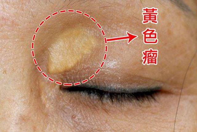 眼皮上长黄色的疙瘩是肿瘤吗？