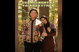 全球首例成功换脸换手男子宣布下月结婚图片