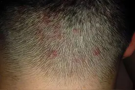头皮总是痒得厉害，一摸都是疙瘩、脓包，怎么回事？能不能抠掉？图片