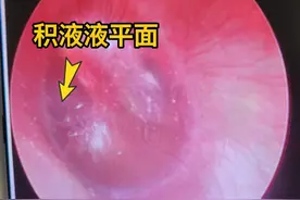 杭州男子阳后耳朵里抽出积液！最近此类患者大增，医生提醒：这个动作千万别做图片
