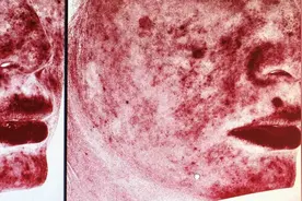 对付玫瑰痤疮，皮肤科医生来教你几招！图片