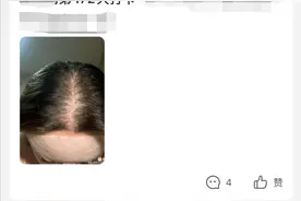 别再问我米诺地尔“狂脱期”了，亲身经历和相关知识都在这了图片