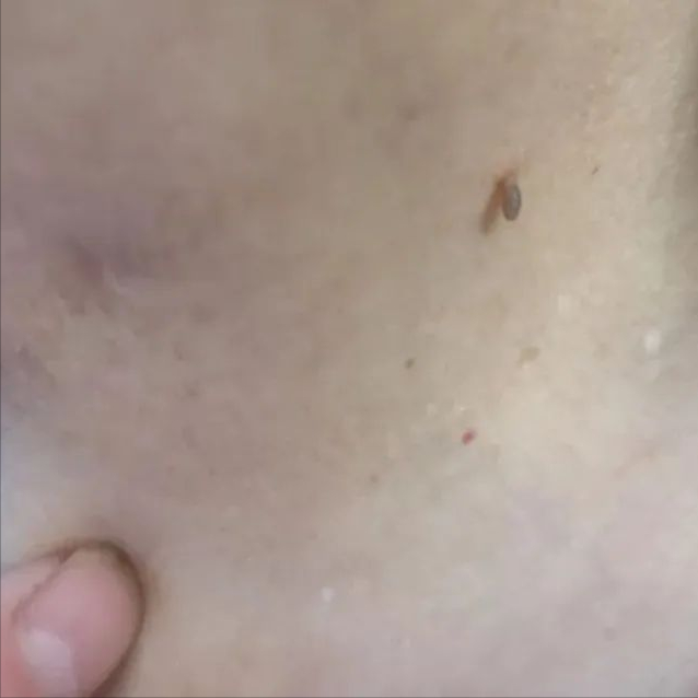 角化棘皮瘤的病理要点
