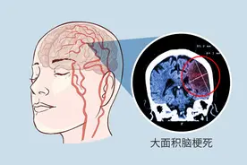 为啥中国脑梗死患者越来越多？厨房里的3种调料滥用或是“帮凶”图片