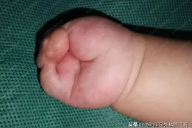 束带综合征造成的复杂并指，术后孩子手的功能“从无到有”图片