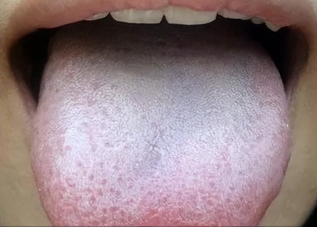 脾虚不调理变成肾阳虚,舌头有齿痕就是身体在提醒你(舌苔白有齿痕是