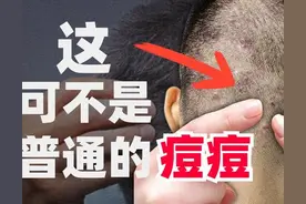 前胸后背长痘痘，是什么原因？简单来讲，可能是没做好这3件事图片