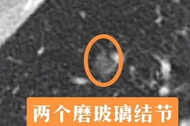 查出2个肺结节，她寝食难安！医生用一根针为她消除“心头大患”图片