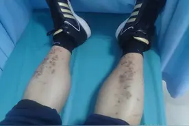 腿部出现这样的现象，可能是糖尿病且有并发症了图片