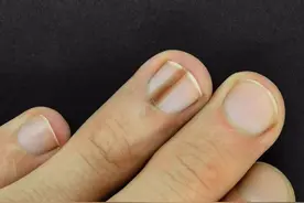 指甲上长了黑线，会是黑色素瘤吗？提醒：警惕2种变化，及时处理图片