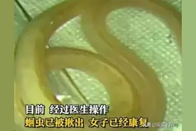 女子长期肚子疼体内发现20cm长蛔虫，据长度判断已在肠道存活两年图片