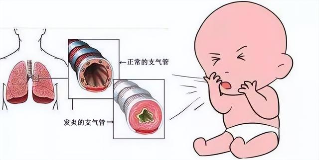 门医科普 | 一分钟带您了解小儿支气管炎