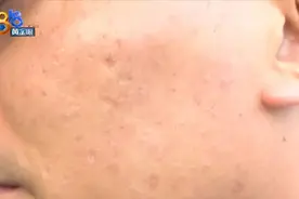 査先生花一万多祛斑 一年过去没效果？图片