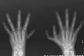 中国首创！西北儿童医院成功为“六指女孩”进行自体多指移植手术图片