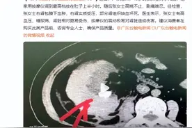 危险！女子用按摩仪减肥把肾压扁进ICU图片
