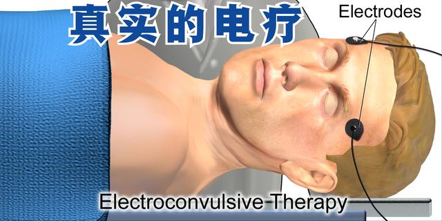 到底什么是电疗,真的那么可怕吗