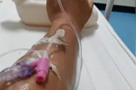 我的肾移植手术费用详细介绍图片