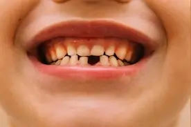 孩子乳牙掉了，迟迟不长新牙是怎么回事？这4点原因妈妈们别忽视图片