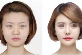 45岁全脸整形：90天“煮妇脸”变“女主脸”，看她做了哪些项目？图片