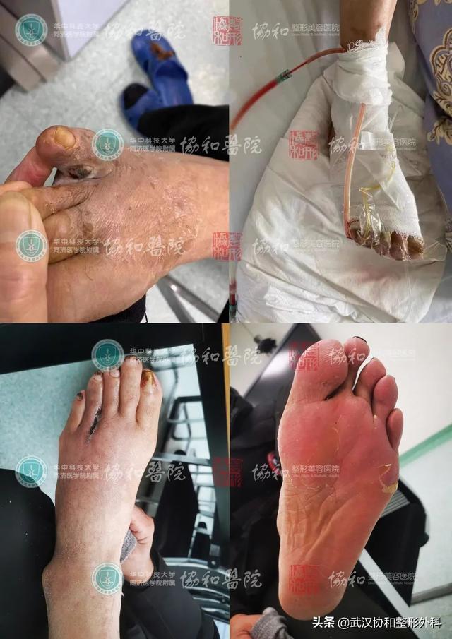 足底过度角化名词解释
