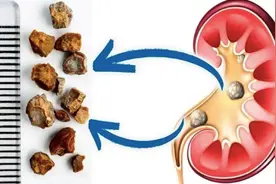 尿路结石的高发季！不疼的“石头”往往憋着大招图片