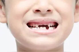 儿童何时开始换牙，应怎样做才能换出一口好牙？图片