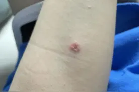 同城领养了个猫，全身都是猫癣还把我传染了图片
