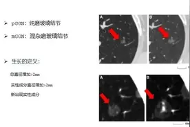 肺磨玻璃结节会不会5年内生长？预测指标在这里图片