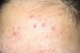 家长注意这7件事，轻松战胜痘痘图片