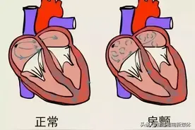 心房颤动临床症状及其预后图片