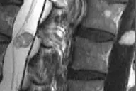 腰椎原发性肿瘤磁共振诊断要点图片