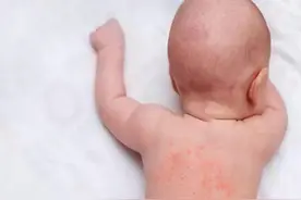 娃被痱子虐惨了？只要别做这3件事，娃就能少受罪！图片