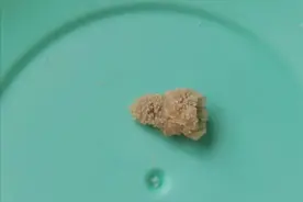 36岁的他肾结石12mm，排出后一捏就碎，到医院检查成分原来是这种图片