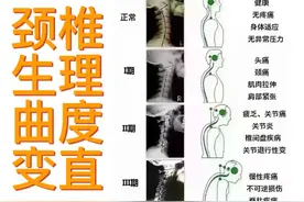 颈椎生理曲度变直了！别担心，能救回来的图片