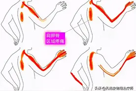 手麻、肩胛骨区域疼痛，是怎么回事？不出意外，这3种可能性最大图片